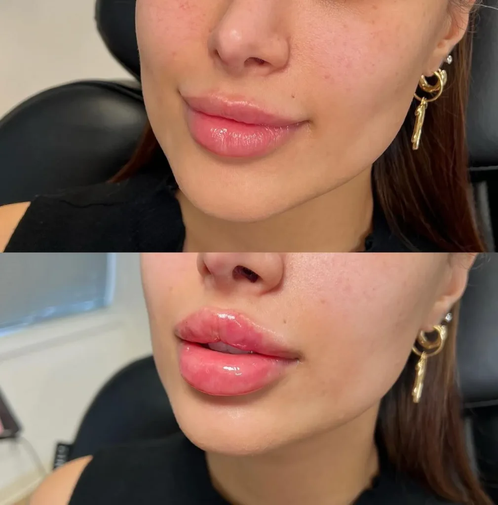 Supa Society | When to Get Filler After Lip Tattoo Aftercare Essentials