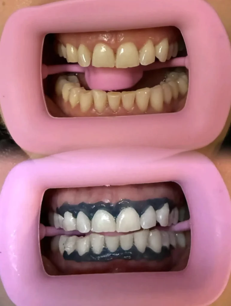 Supa Society | How Can I Naturally Whiten My Teeth? At-Home Options That Can Help
