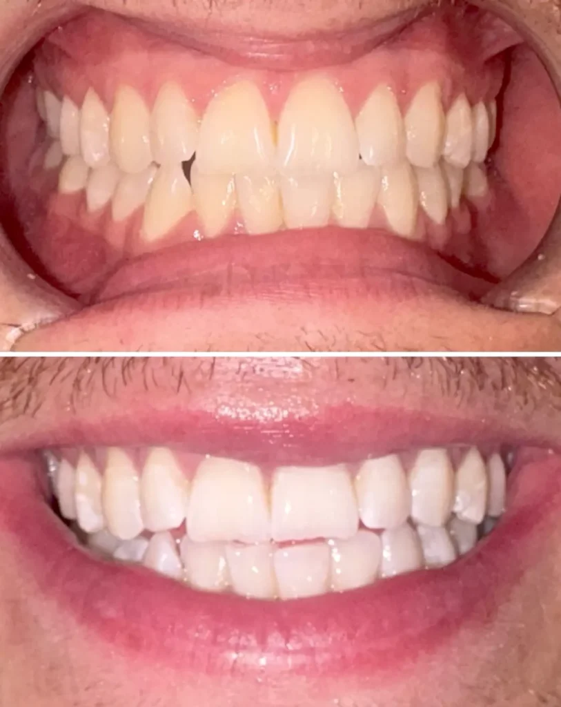 Supa Society | How Can I Naturally Whiten My Teeth? Brisbane Lifestyle Tips