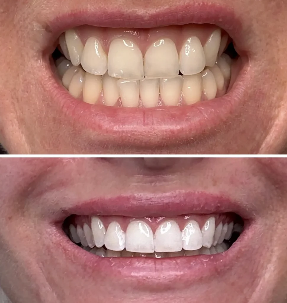 Supa Society | How Can I Naturally Whiten My Teeth? Even if Social Media Says Otherwise