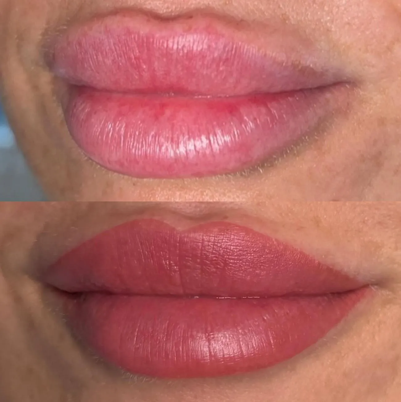 Supa Society | Who Can’t Get a Lip Blush Tattoo? Keloids or Hypertrophic Scars
