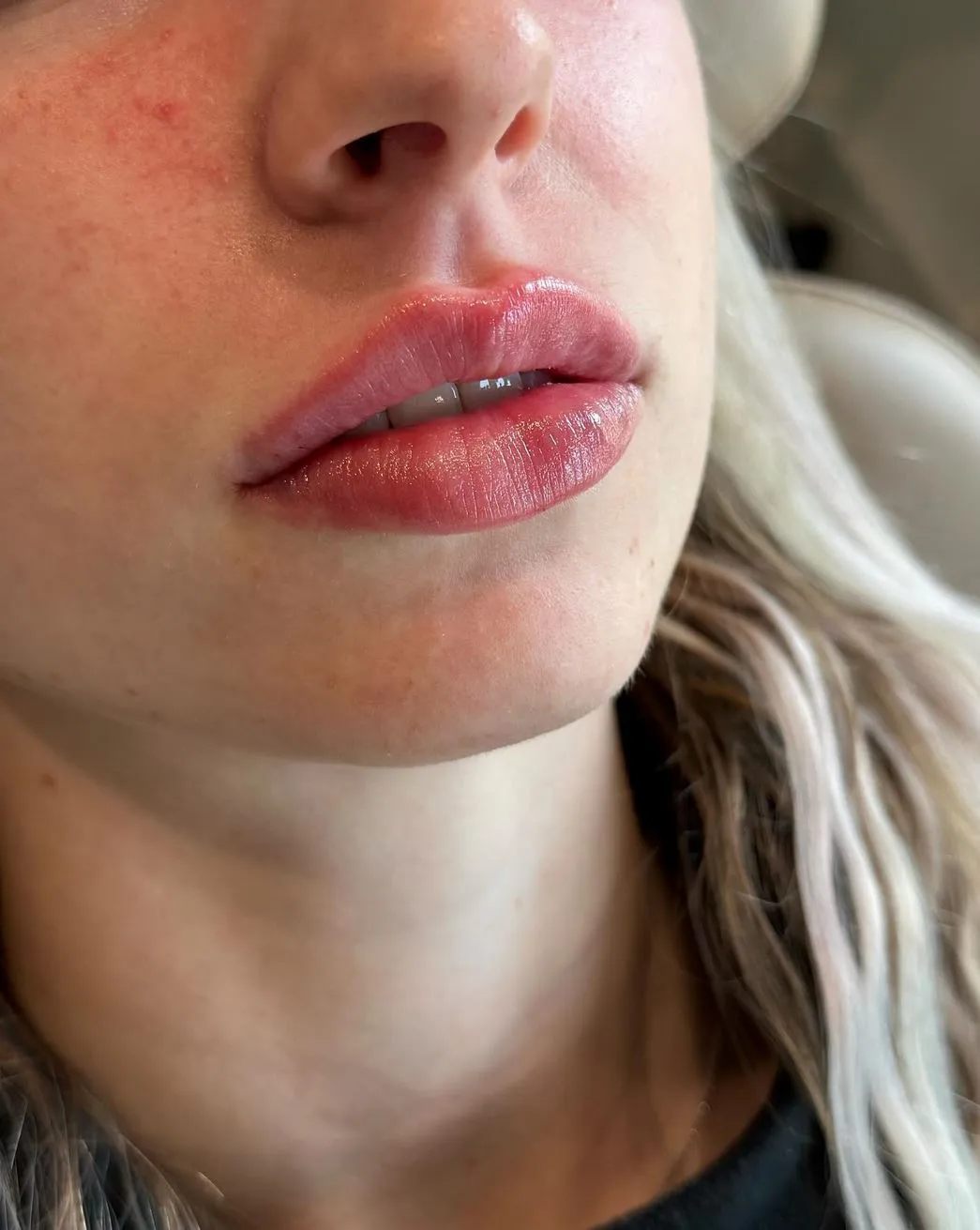 Supa Society | When to Get Filler After Lip Tattoo Lip Implants vs. Fillers