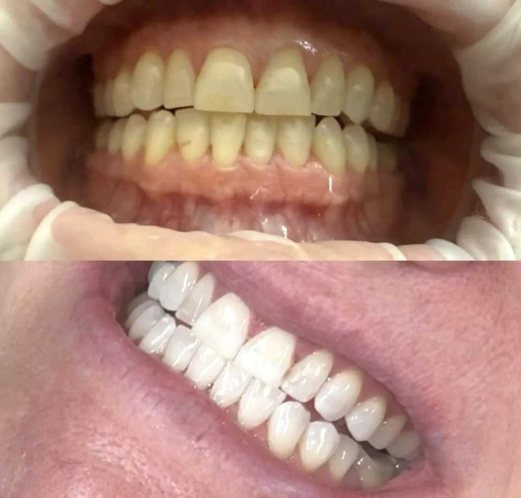 Supa Society | How Can I Naturally Whiten My Teeth? Real Results Take Real Habits