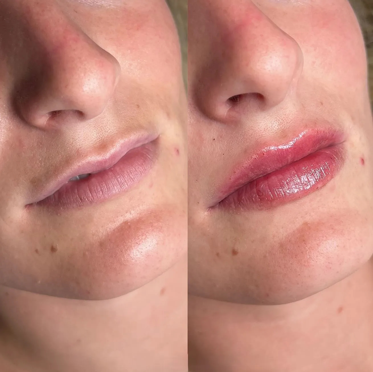 Supa Society | When to Get Filler After Lip Tattoo Recommended Waiting Period