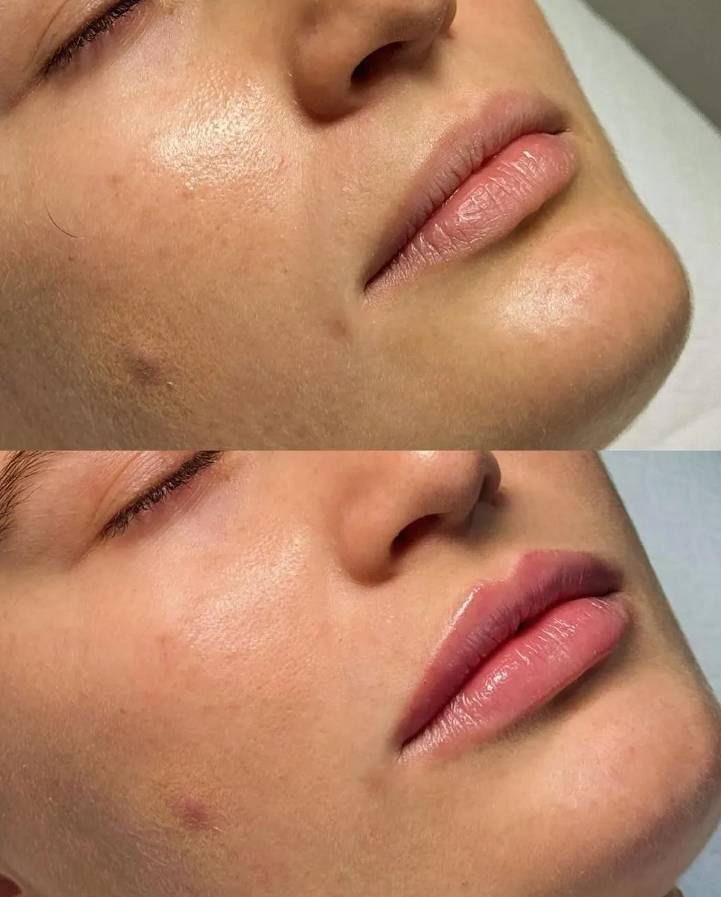 Supa Society | When to Get Filler After Lip Tattoo Skin Types and Color Outcomes