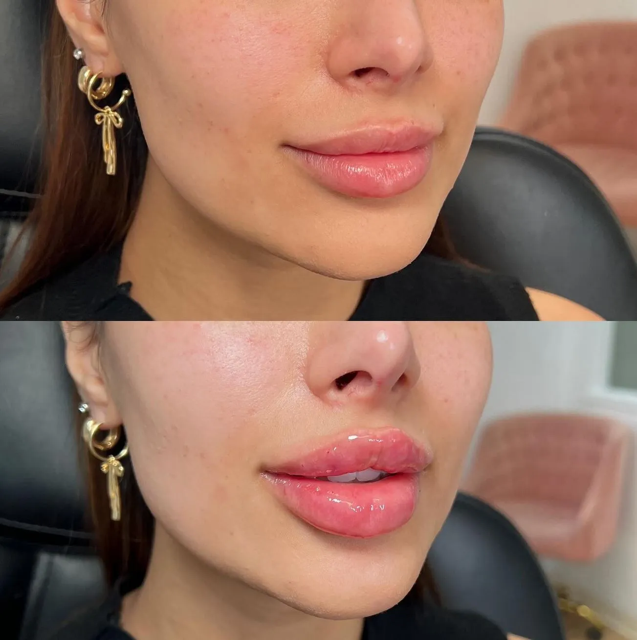 Supa Society | When to Get Filler After Lip Tattoo The Sequence of Treatments