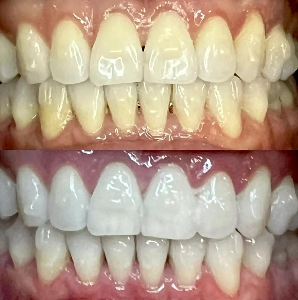 Supa Society | How Can I Naturally Whiten My Teeth? What Actually Works