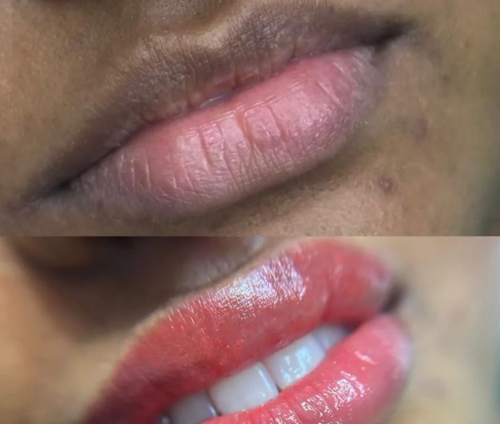 What Are the Potential Side Effects of Lip Neutralisation