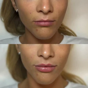 When to Get Filler After Lip Tattoo