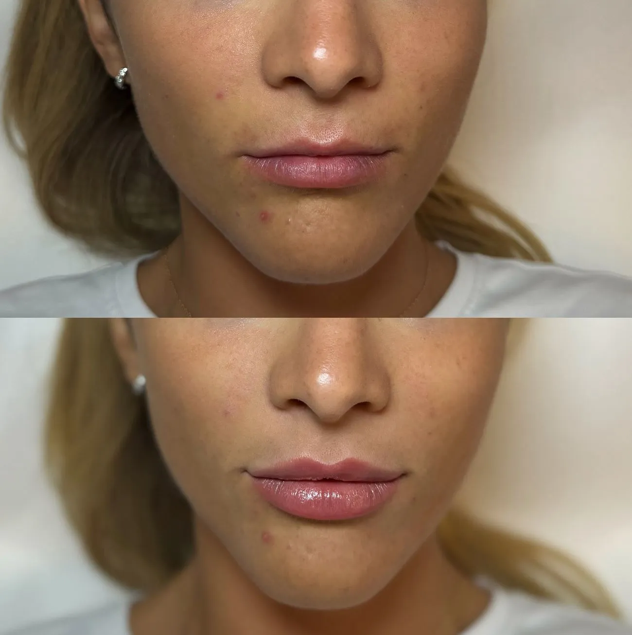 Supa Society | When to Get Filler After Lip Tattoo When to Get Filler After Lip Tattoo