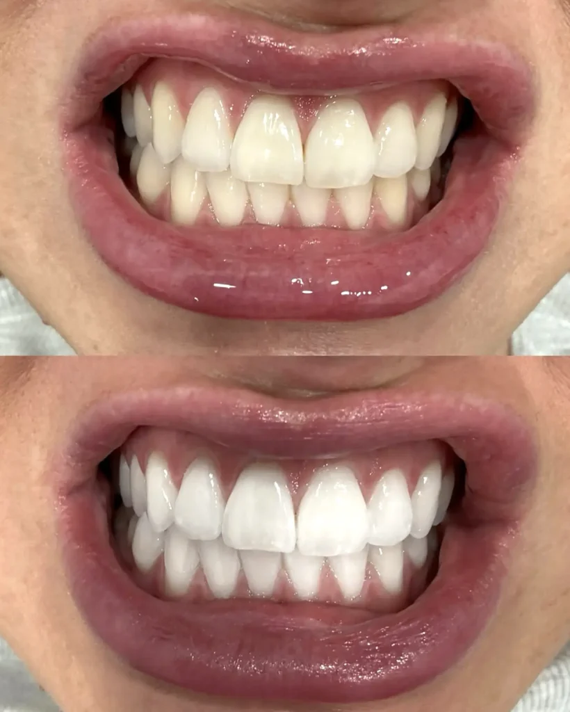 Supa Society | How Can I Naturally Whiten My Teeth? Whitening Without Compromise