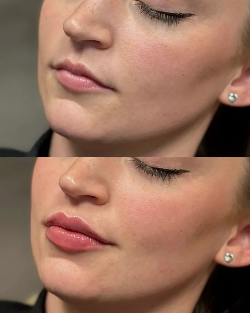 Supa Society | When to Get Filler After Lip Tattoo Why Timing Matters