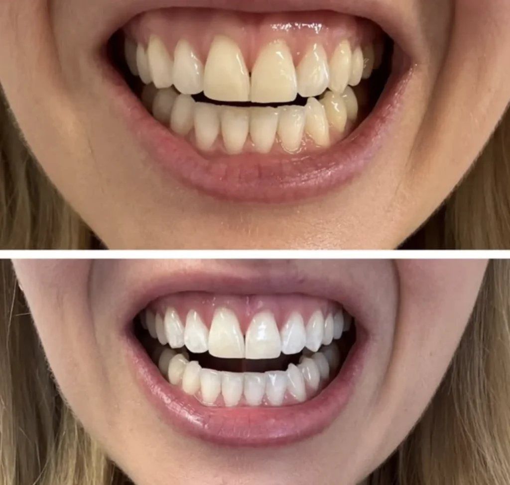 Supa Society | How Can I Naturally Whiten My Teeth? teeth whitening Brisbane